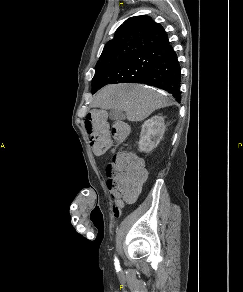 Aortoenteric fistula (Radiopaedia 84308-99603 C 85).jpg