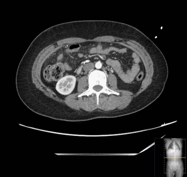 File:Appendicitis (CT angiogram) (Radiopaedia 154713-127660 Axial 85).jpg