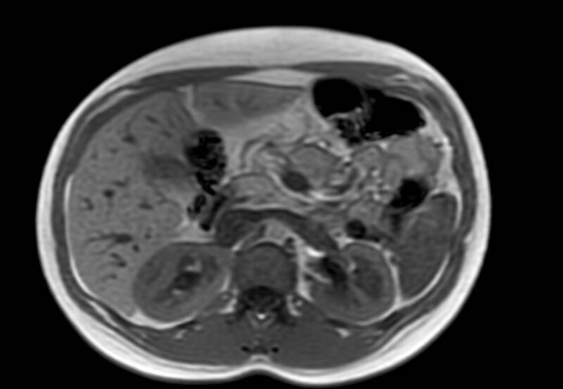 File:Appendicitis in gravida (MRI) (Radiopaedia 89433-106395 Axial T1 in-phase 20).jpg