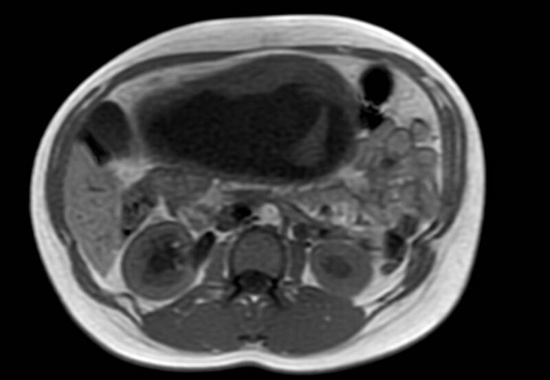 File:Appendicitis in gravida (MRI) (Radiopaedia 89433-106395 Axial T1 in-phase 27).jpg