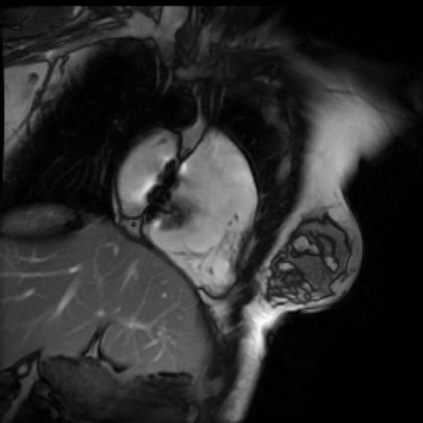 Arrhythmogenic right ventricular cardiomyopathy (Radiopaedia 87505-103850 2ch (RV) Cine SSFP 73).jpg