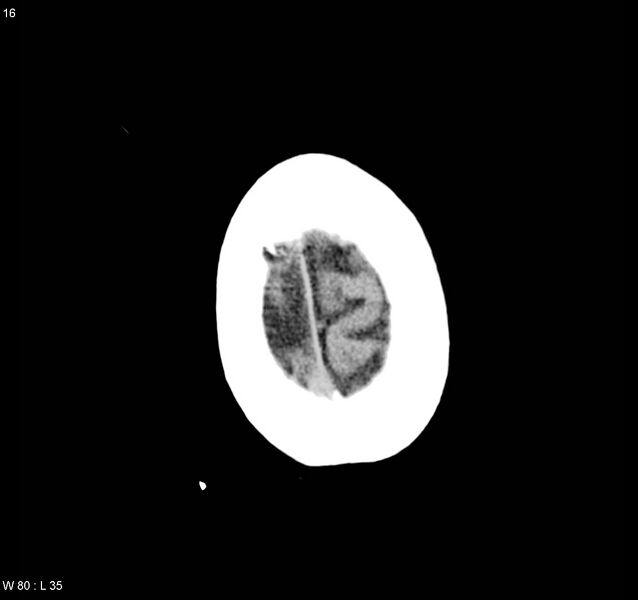 File:Arteriovenous malformation - cerebral (Radiopaedia 8172-9020 Axial non-contrast 24).jpg