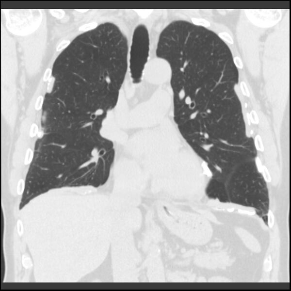 File:Asbestos-related pleural plaques (Radiopaedia 39069-41255 Coronal lung window 49).jpg