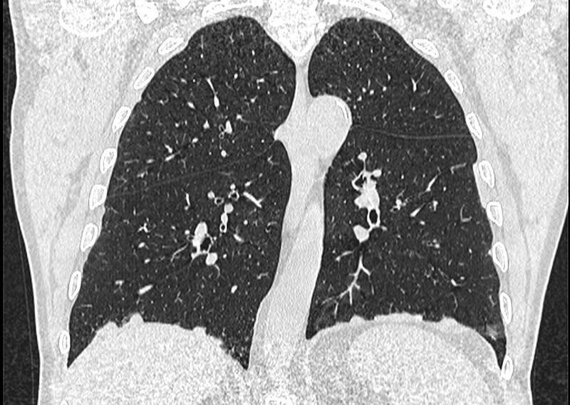 File:Asbestos pleural placques (Radiopaedia 57905-64872 Coronal lung window 183).jpg