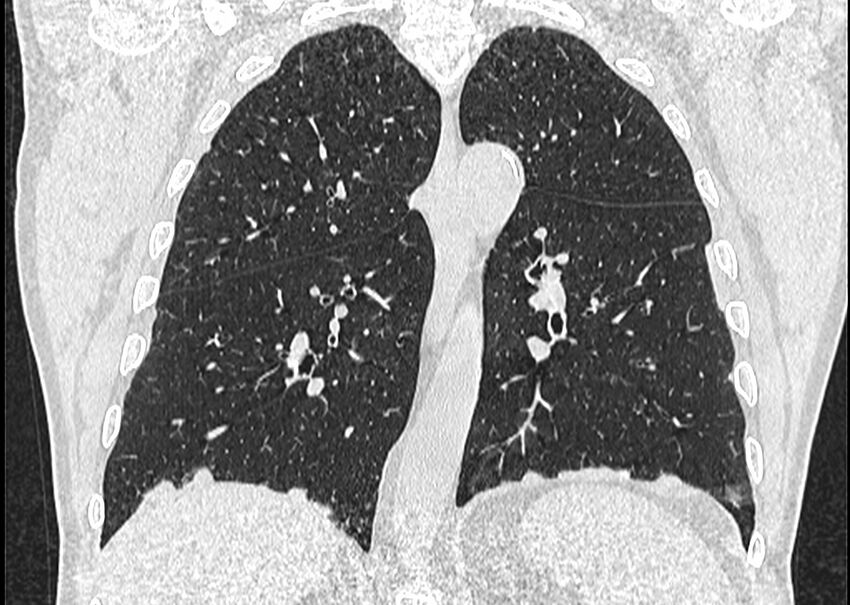 Asbestos pleural placques (Radiopaedia 57905-64872 Coronal lung window 183).jpg