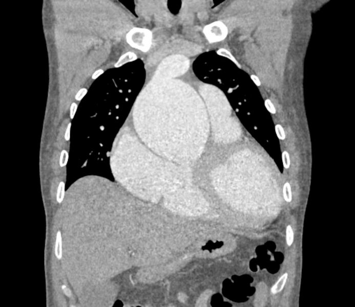 File:Ascending aortic aneurysm (Radiopaedia 86279-102297 B 19).jpg