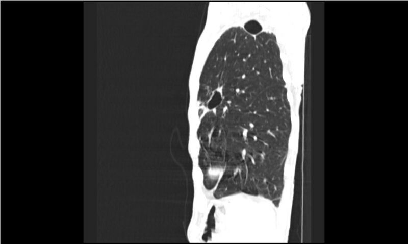 File:Aspergilloma (Radiopaedia 20788-20701 Sagittal lung window 3).jpg