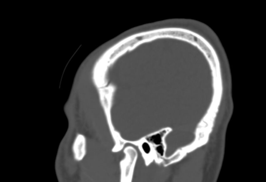 Asymptomatic occipital spur (Radiopaedia 87753-104201 Sagittal bone window 274).jpg