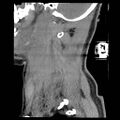 Atlanto-occipital dislocation (Radiopaedia 44648-48412 A 25).jpg