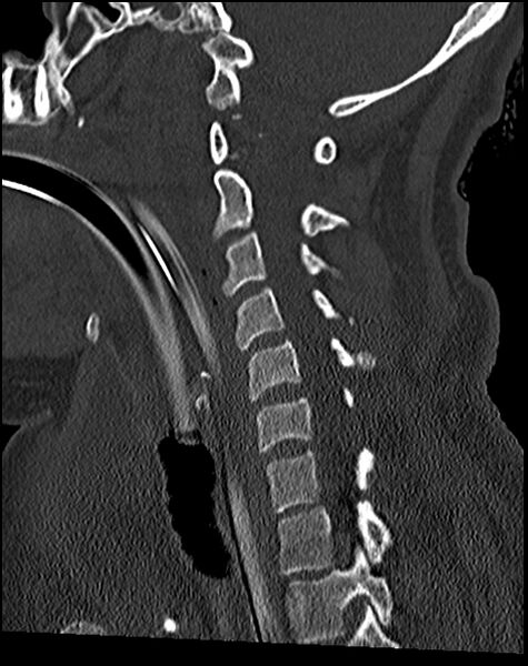 File:Atlanto-occipital dissociation - Traynelis type 1 (Radiopaedia 87570-103948 Sagittal bone window 50).jpg