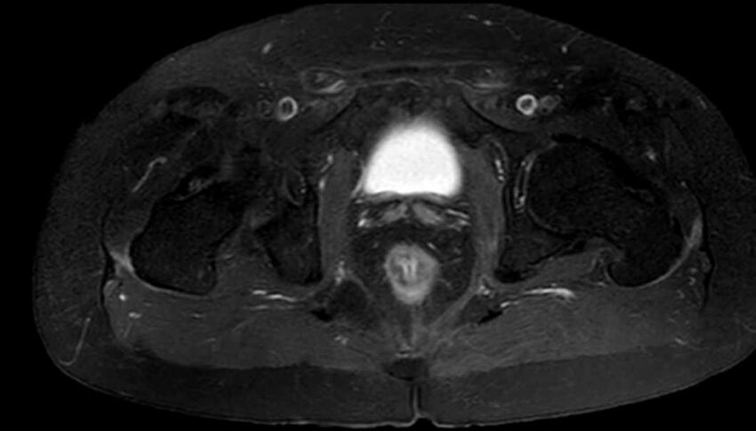 Atypical lipomatous tumor - thigh (Radiopaedia 68975-78734 Axial T1 C+ fat sat 90).jpg