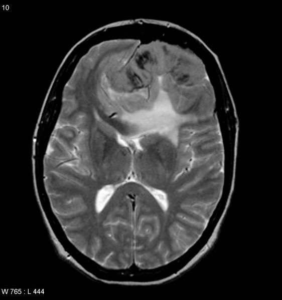 File:Atypical meningioma (WHO grade II) (Radiopaedia 7762-8586 Axial T2 2).jpg