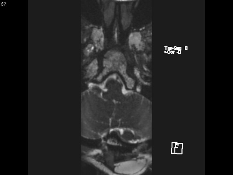 File:Atypical meningioma - intraosseous (Radiopaedia 64915-74572 Axial CISS 67).jpg