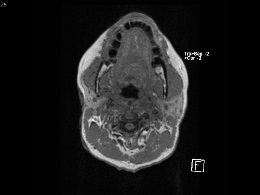 Atypical meningioma - intraosseous (Radiopaedia 64915-74572 Axial T1 25).jpg