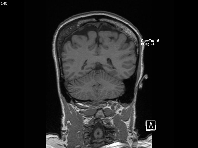 File:Atypical meningioma - intraosseous (Radiopaedia 64915-74572 Coronal T1 140).jpg