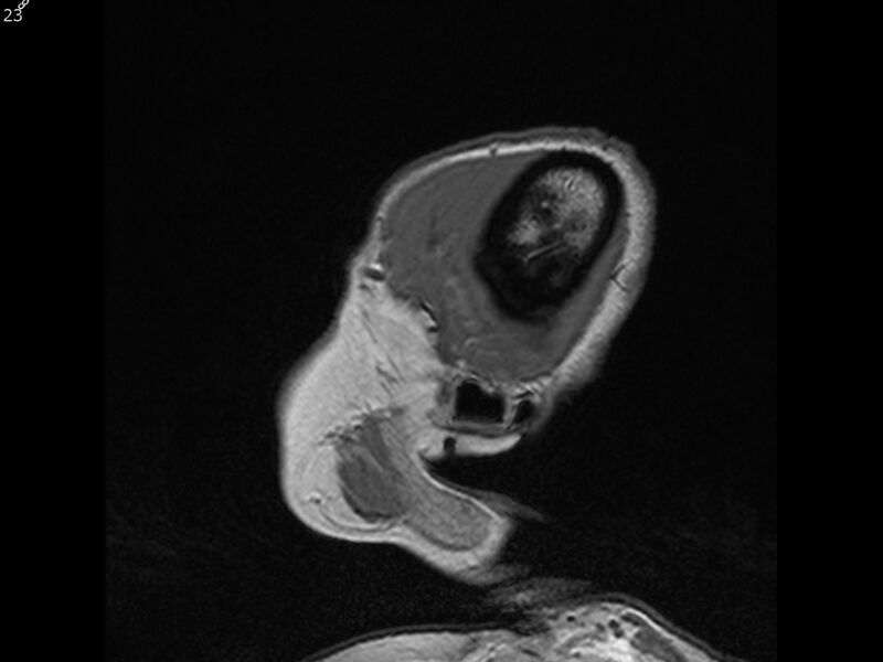 File:Atypical meningioma - intraosseous (Radiopaedia 64915-74572 Sagittal T1 23).jpg