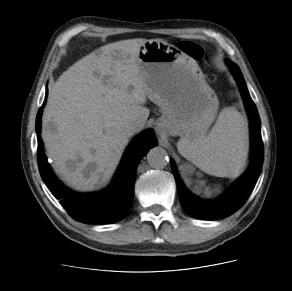File:Autosomal dominant polycystic kidney disease (Radiopaedia 27851-28094 Axial non-contrast 50).jpg
