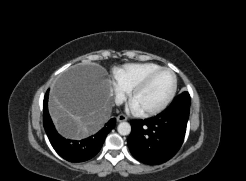 File:Autosomal dominant polycystic kidney disease (Radiopaedia 57124-64017 A 14).jpg