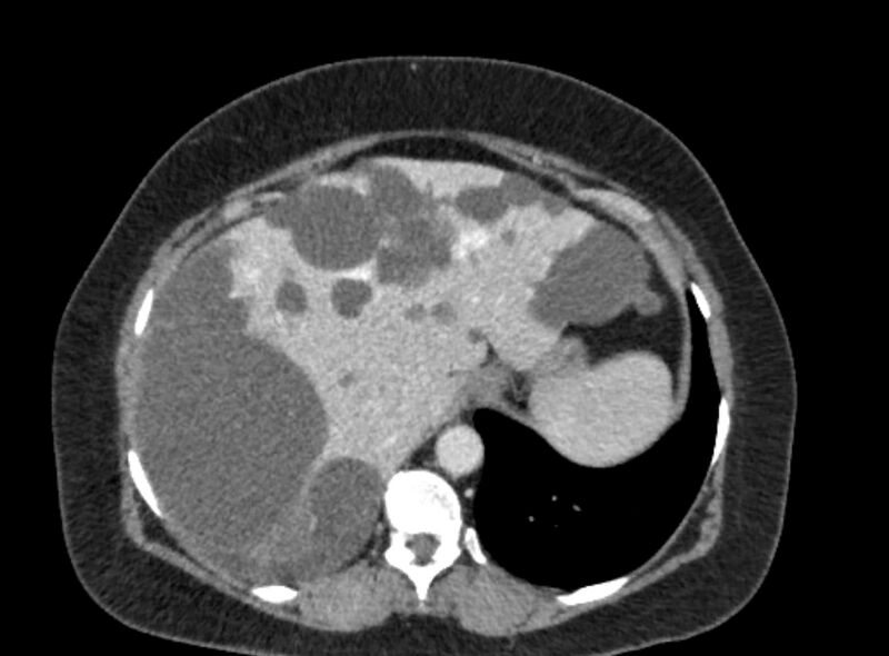 File:Autosomal dominant polycystic kidney disease (Radiopaedia 57124-64017 A 27).jpg