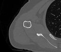 Avulsion fracture - greater tuberosity of humerus (Radiopaedia 71216-81514 Axial bone window 57).jpg