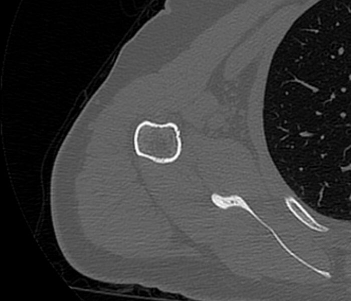 File:Avulsion fracture - greater tuberosity of humerus (Radiopaedia 71216-81514 Axial bone window 57).jpg