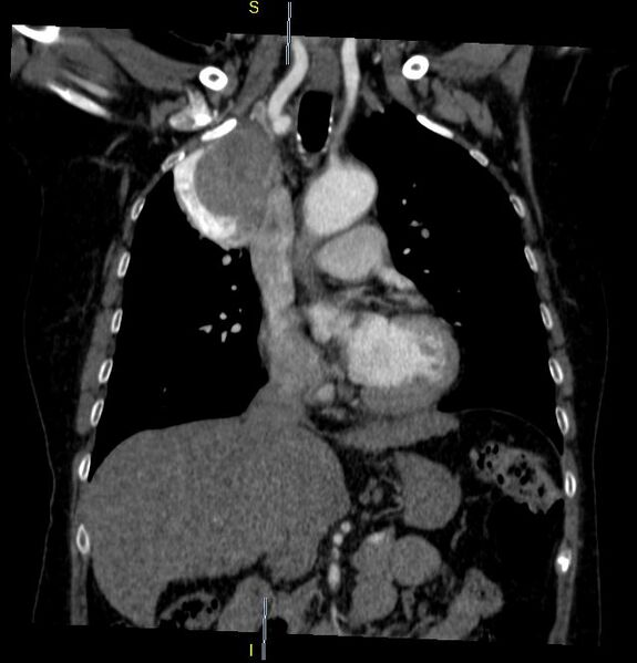 File:Azygos vein aneurysm (Radiopaedia 77824-90130 C 14).JPG