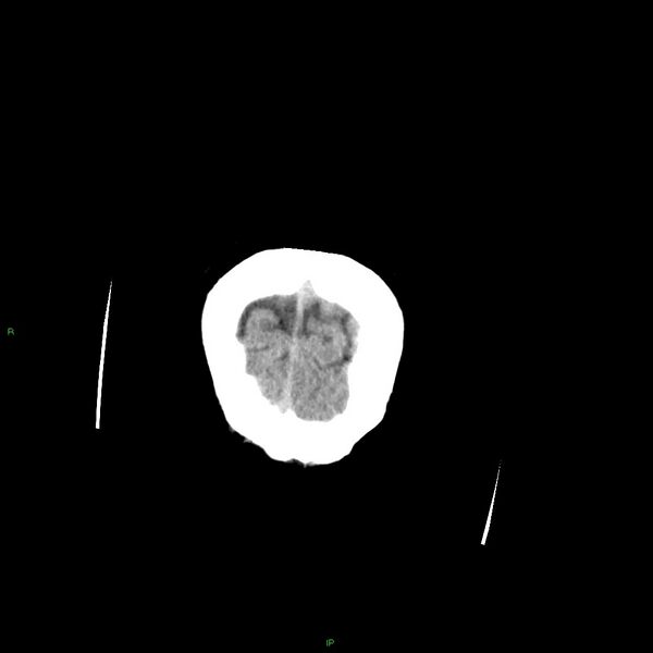 File:Basal ganglia hemorrhage (Radiopaedia 58349-65472 Coronal non-contrast 6).jpg