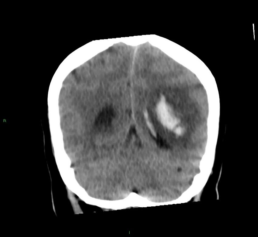 Basal ganglia hemorrhage (Radiopaedia 58759-65981 Coronal non-contrast 25).jpg