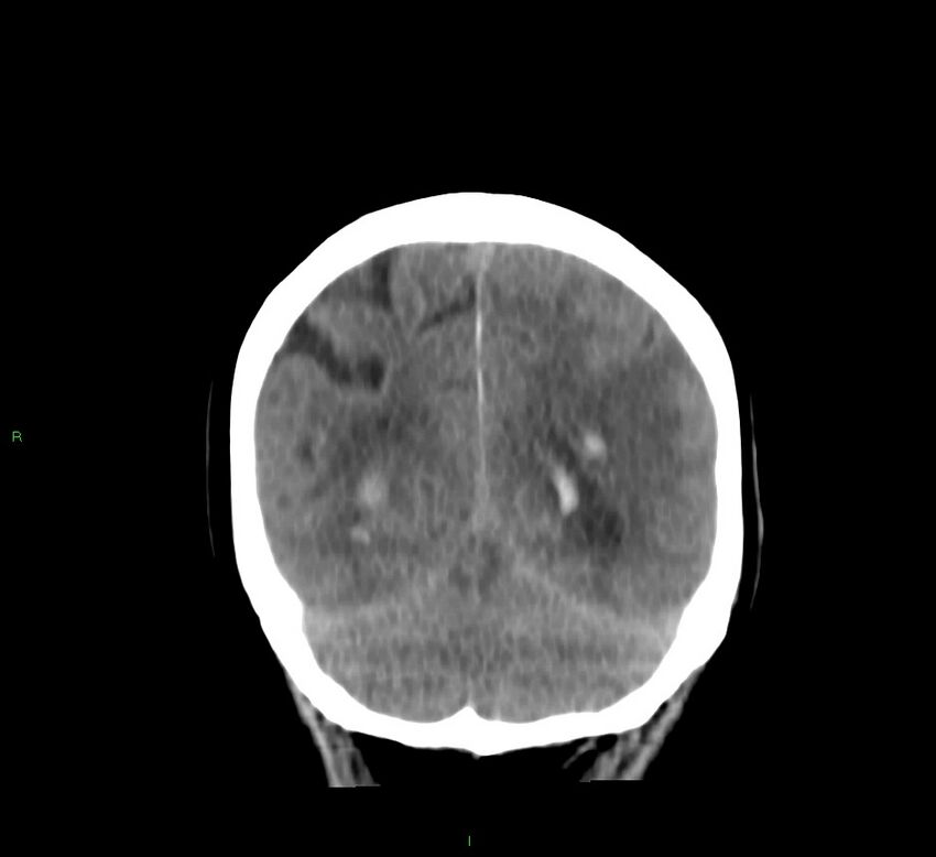 Basal ganglia hemorrhage (Radiopaedia 58767-65989 Coronal non-contrast 19).jpg