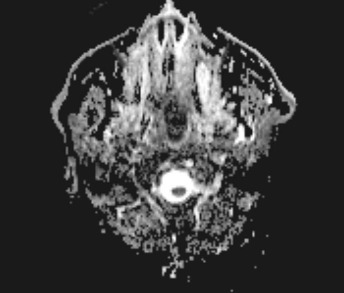 File:Basilar artery dissection (Radiopaedia 77032-88976 Axial ADC 1).jpg