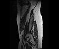 Bicornuate bicollis uterus (Radiopaedia 61626-69616 Sagittal T2 4).jpg