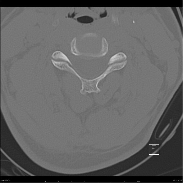 File:Bilateral cervical ribs (Radiopaedia 25868-26017 Axial bone window 23).jpg