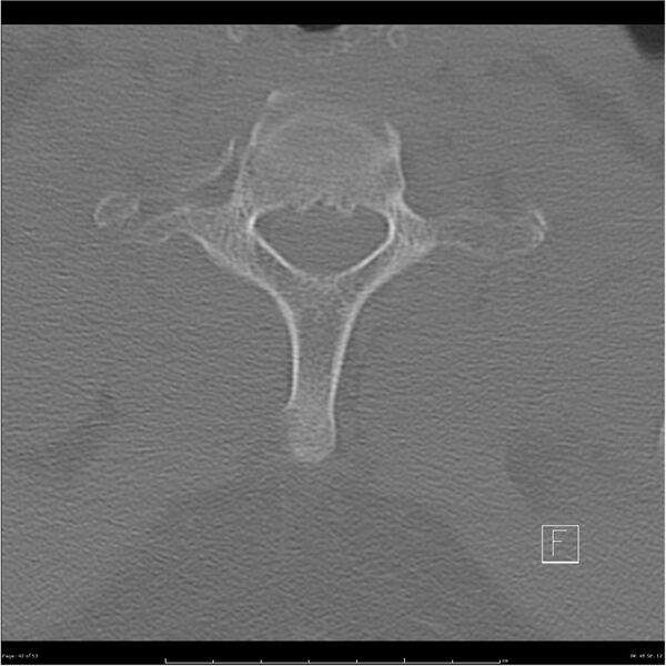File:Bilateral cervical ribs (Radiopaedia 25868-26017 Axial bone window 42).jpg