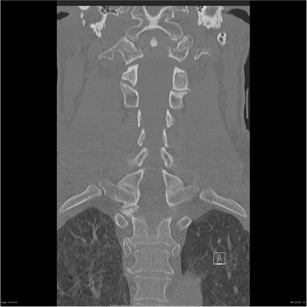 File:Bilateral cervical ribs (Radiopaedia 25868-26017 Coronal bone window 24).jpg