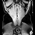 Bilateral conjoined nerve roots at different levels (Radiopaedia 73312-84063 Coronal WE 51).jpg