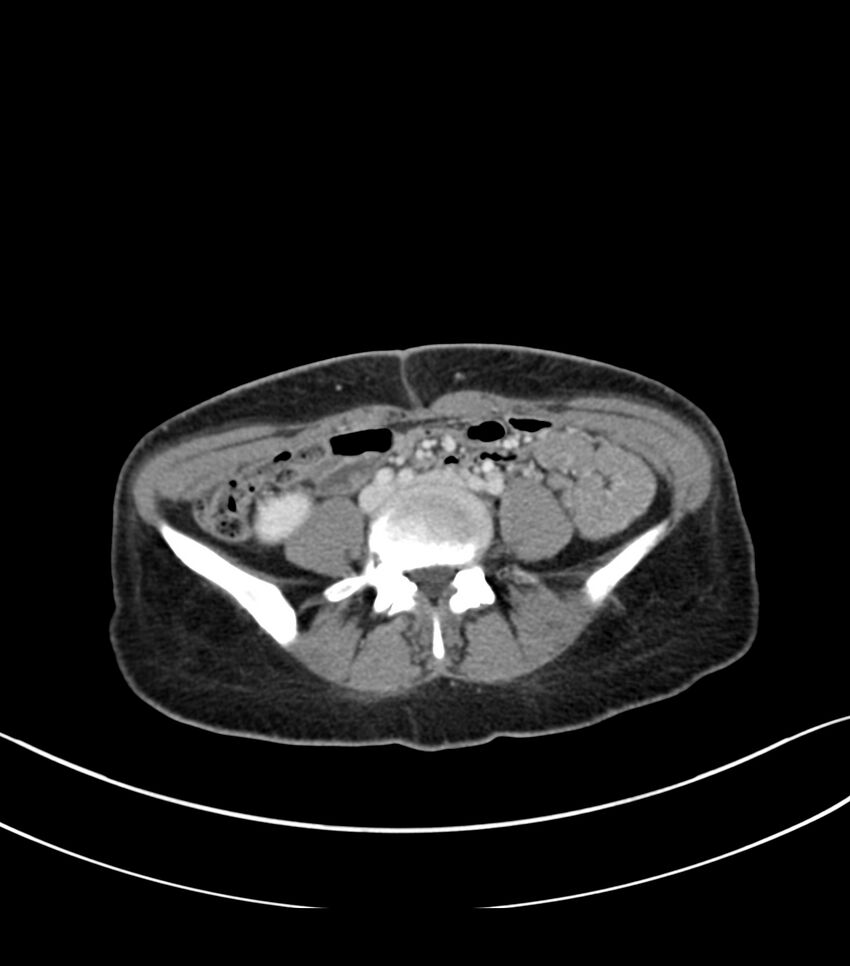 Bilateral kidney malrotation (Radiopaedia 72227-82749 A 46).jpg