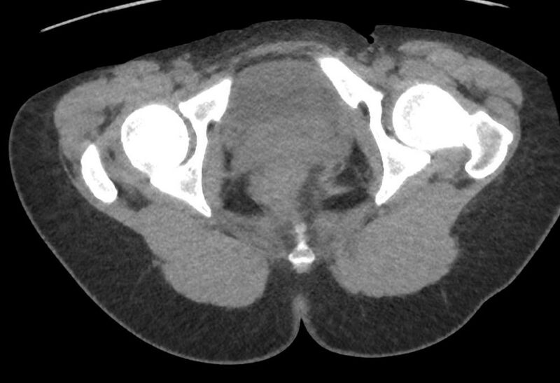 File:Bilateral mature cystic ovarian teratoma (Radiopaedia 88821-105592 Axial non-contrast 54).jpg