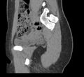 Bilateral mature cystic ovarian teratoma (Radiopaedia 88821-105592 D 12).jpg