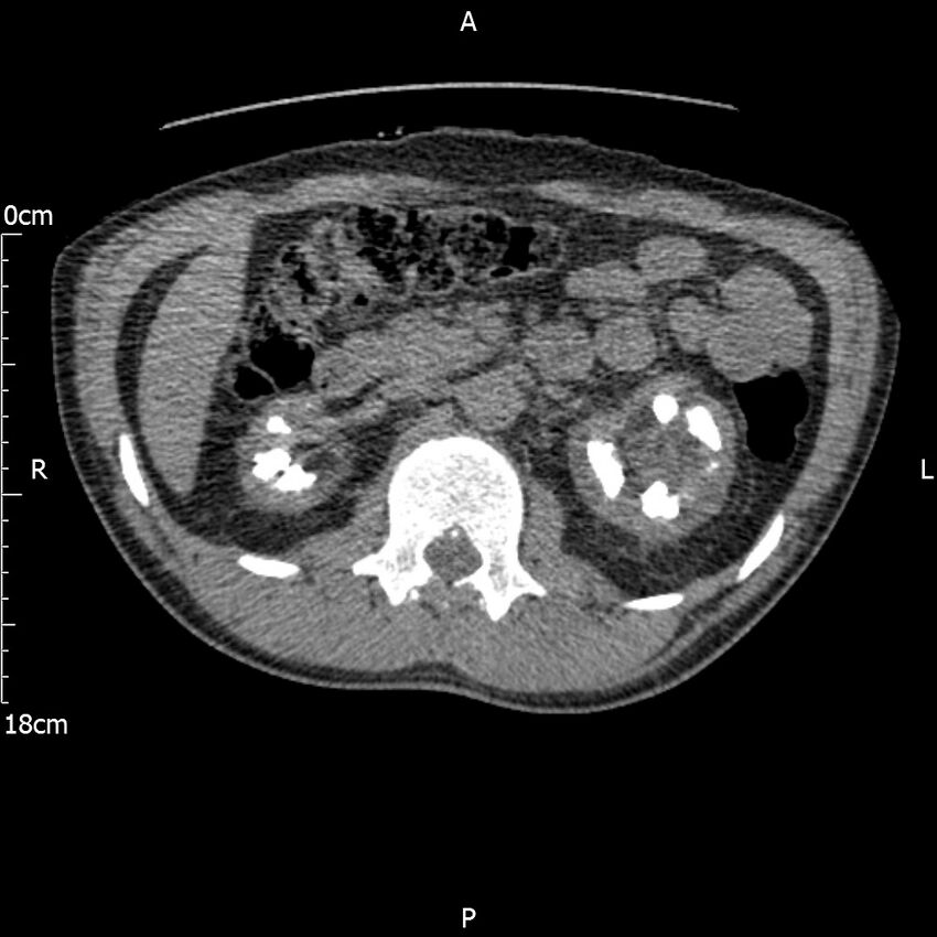 Bilateral medullary nephrocalcinosis with ureteric calculi (Radiopaedia 71269-81569 Axial non-contrast 41).jpg