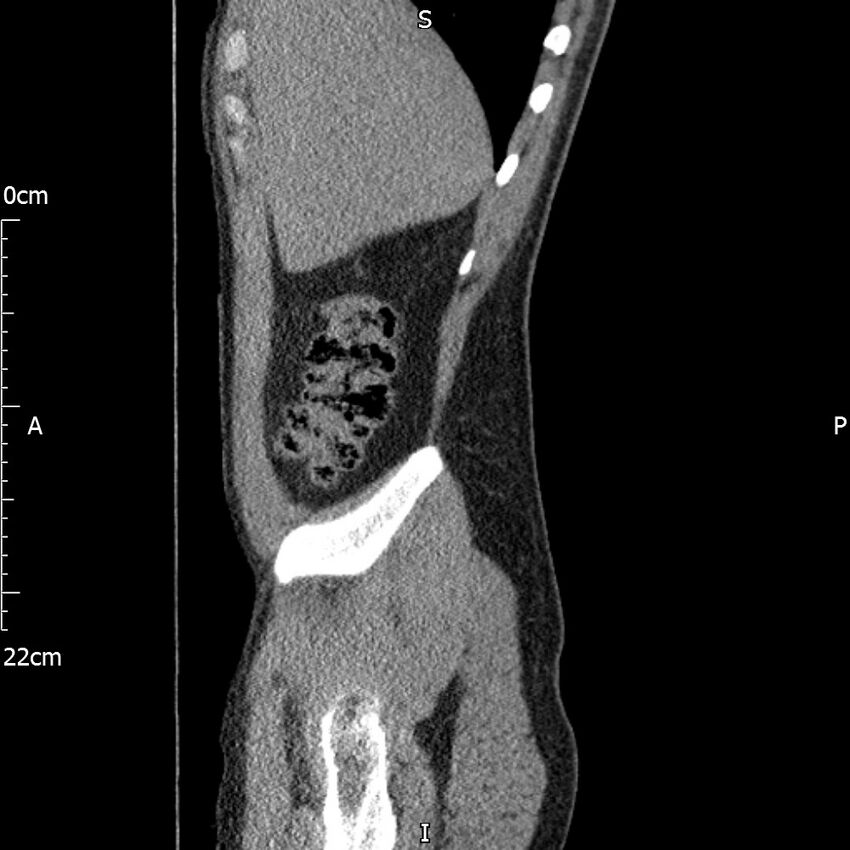Bilateral medullary nephrocalcinosis with ureteric calculi (Radiopaedia 71269-81569 C 94).jpg