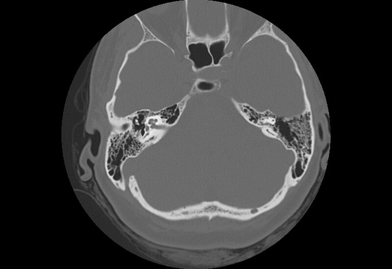 File:Bilateral otospongiosis (Radiopaedia 35447-36940 Axial bone window 33).jpg