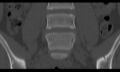 Bilateral pars defect (Radiopaedia 26691-26846 Coronal bone window 16).jpg