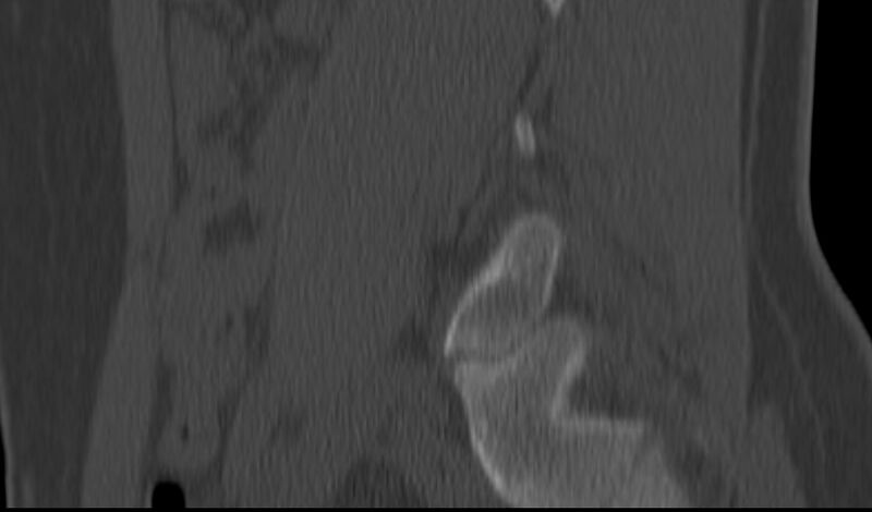 File:Bilateral pars defect (Radiopaedia 26691-26846 Sagittal bone window 49).jpg