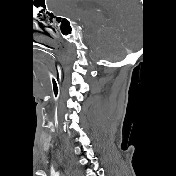 File:Bilateral perched facets with cord injury (Radiopaedia 45587-49713 B 18).jpg