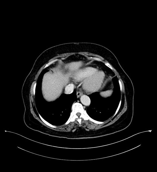 File:Bilateral sporadic synchronous clear cell renal cell carcinoma (Radiopaedia 85035-100575 C 10).jpg