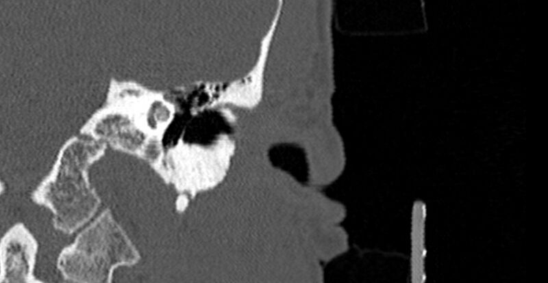 File:Bilateral temporal bone fractures (Radiopaedia 29482-29970 B 18).jpg