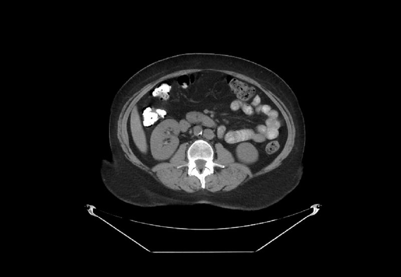File:Bilateral urolithiasis with incidentally detected splenic artery aneurysm and left inferior vena cava (Radiopaedia 44467-48123 Axial non-contrast 26).jpg