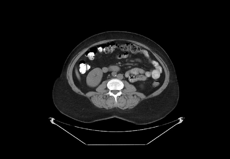 File:Bilateral urolithiasis with incidentally detected splenic artery aneurysm and left inferior vena cava (Radiopaedia 44467-48123 Axial non-contrast 29).jpg