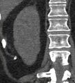 Bile leak from accessory duct(s) of Luschka post cholecystectomy (Radiopaedia 40736-43389 B 59).jpg