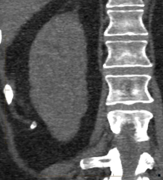 File:Bile leak from accessory duct(s) of Luschka post cholecystectomy (Radiopaedia 40736-43389 B 59).jpg